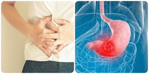 7 dấu hiệu ung thư dạ dày thường gặp