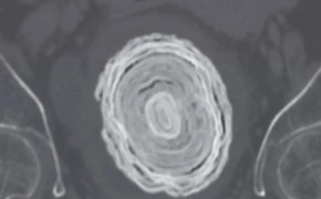 Liên tục tiểu ra máu, đi khám phát hiện thứ to như quả bóng chày trong cơ thể