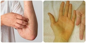 Triệu chứng ung thư gan giai đoạn đầu
