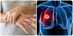 Ung thư phổi: 4 dấu hiệu bất thường xuất hiện ở tay, chân không nên chủ quan