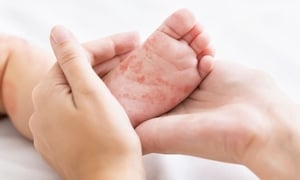 Bé gái 4 tuổi ở Hà Nội tử vong do mắc sởi