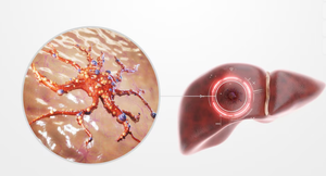 4 thực phẩm là 'hung thần' bức tử gan, nên làm 2 việc để cứu gan