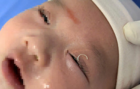 Mẹ cắt móng tay văng vào mắt con 2 tháng tuổi gây viêm sưng