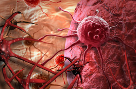 Phát hiện ung thư hiếm gặp xâm lấn bàng quang sau nhiều lần phẫu thuật