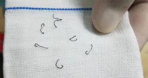 Sau cắt trĩ, người phụ nữ phải nhập viện nhổ đinh 8 lần và bị suy thận