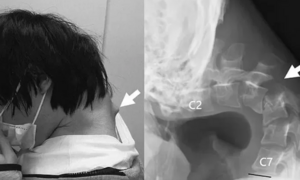Nhìn điện thoại quá nhiều, nam thanh niên không thể ngẩng đầu