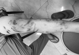 Tổn thương chằng chịt cơ thể do bị sứa chích khi tắm biển