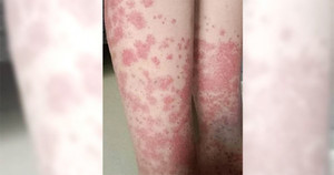 Nữ sinh trả giá đắt vì nhuộm tóc liên tục: Thận chảy máu, phải cạo đầu giữ mạng