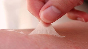 Dùng axit tẩy trắng da, cô gái bị bỏng toàn thân