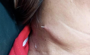 Người phụ nữ bị xương cá dài 2cm đâm xuyên qua cổ