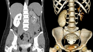 Thận 'hóa đá' khi mới 18 tuổi