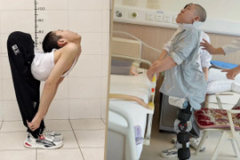 Chàng trai có cột sống gập hình chữ Z lần đầu đứng thẳng sau nhiều ca phẫu thuật