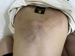 Bé 4 tuổi ở Hà Nội bị giáo viên đánh tím lưng vì 'không chịu đi ngủ'