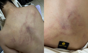 Vụ bé gái 4 tuổi bị đánh tím lưng: Đình chỉ thêm 1 giáo viên