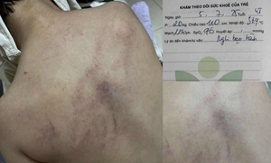 Bé gái 4 tuổi bị cô giáo ném vào tường, đánh tím lưng: Bộ Y tế vào cuộc