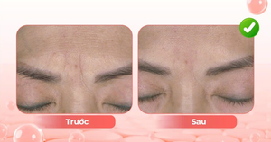 Trẻ hóa da tuổi trung niên bằng chiếu đèn LED