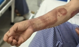 Ba năm mang 'chấm lạ', hai cha con đi khám mới biết mắc bệnh phong