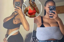 Ngực lép thành khổng lồ trong vài tháng, cô gái sợ hãi khi biết nguyên nhân