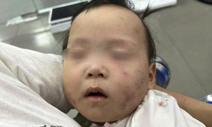 Làm rõ nguyên nhân bé gái bị bầm tím mặt khi gửi ở nhà trẻ Bắc Ninh