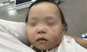 Bé gái 1 tuổi bị bầm tím mặt khi gửi nhà trẻ ở Bắc Ninh: Công an tạm giữ cô giáo