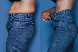 Phẫu thuật ‘nắn’ xương sườn giúp cô gái gen Z có vòng eo con kiến, giảm 15cm