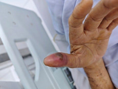 Cứu sống cụ ông ở TP.HCM bị rắn lục đuôi đỏ cắn nguy kịch