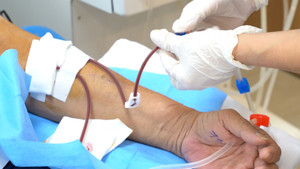 Nhiều người trẻ suy thận do biến chứng từ viêm cầu thận IgA 