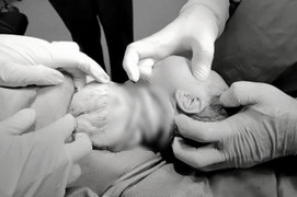 Bé gái chào đời với 6 vòng dây rốn quấn cổ, mẹ tiền sản giật