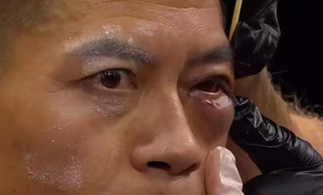 Đi thi tát bị đánh bất tỉnh, cao thủ Trung Quốc nguy cơ thương tật vĩnh viễn