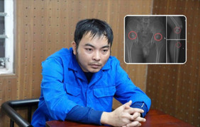 Cựu nhân viên y tế đục vỡ xương trục lợi bảo hiểm: Thủ đoạn tàn nhẫn, bất nhân