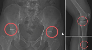 Tự đục vỡ xương để trục lợi bảo hiểm: Quá sợ kẻ vì tiền mà độc ác với chính mình