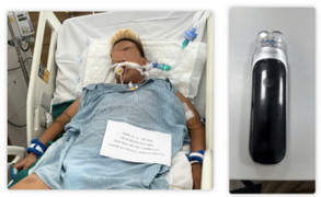 Suy thận, phổi tắc nghẽn vì hút thuốc lá điện tử từ năm 13 tuổi