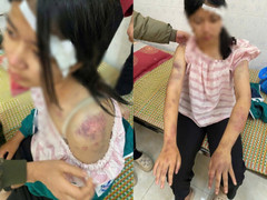 Bé gái bị người nhà đánh đập, tra tấn dã man vì nghi trộm tiền