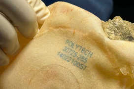 Ưu điểm tháo túi ngực và thay túi ngực, mê mask thanh quản