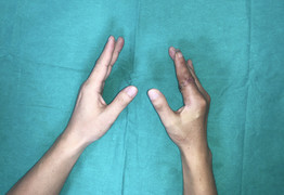 Ngón tay thủy thủ 'sống lại' sau 25 giờ đứt rời giữa tâm bão