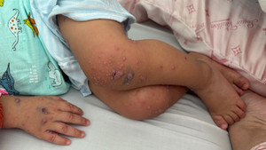 Nhiều trẻ mắc tay chân miệng trở nặng do tác nhân EV71, bác sĩ khuyến cáo gì?