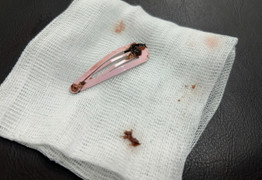 Gắp kẹp tóc dài 7cm khỏi dạ dày bé gái 6 tuổi 