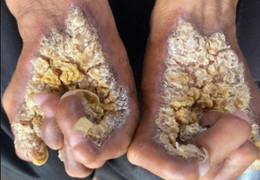 Da xù xì như mọc nấm vì hội chứng lạ