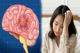 Đau đầu tưởng tiền đình nhưng có thể là 'chỉ điểm' của bệnh trọng