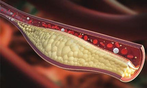 Máu nhiễm mỡ nguy hiểm thế nào?