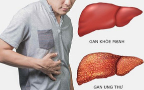 Ung thư gan có chữa khỏi?