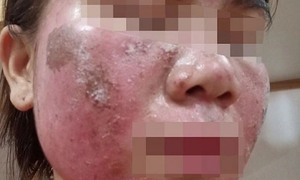 'Vỡ mộng' da đẹp đón Tết: Tan nát mặt vì tự peel da theo hướng dẫn trên mạng