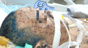 Lây thủy đậu từ con, bố 36 tuổi nguy kịch vì biến chứng nặng