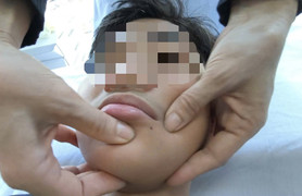 Liệt dây thần kinh số 7 do rét đậm