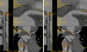 Chỉ đau tức ngực trái thoáng qua, không ngờ phát hiện bệnh lý tim mạch nguy hiểm