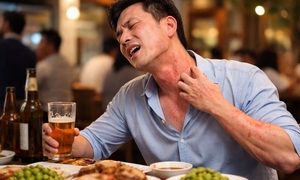 Uống vài ngụm rượu đã nổi mề đay, khó thở: Dấu hiệu dị ứng đe dọa tính mạng