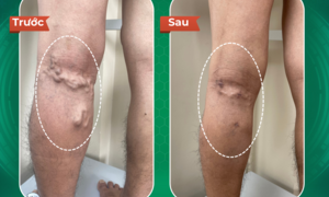 Hồi phục sau điều trị giãn tĩnh mạch tại Dr.Vein
