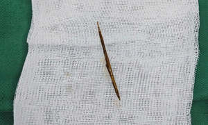 Thủng ruột vì thói quen ngậm tăm sau ăn nhiều người mắc