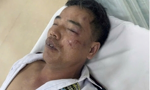 Truy tìm nhóm thanh niên nẹt pô, đánh bảo vệ gãy xương sườn