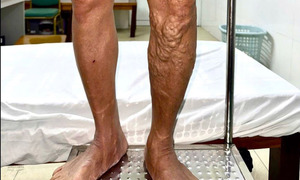 Chân bỗng nổi 'sợi dây thừng' ngoằn ngoèo vì đứng lâu, đi lại nhiều